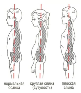 виды осанки